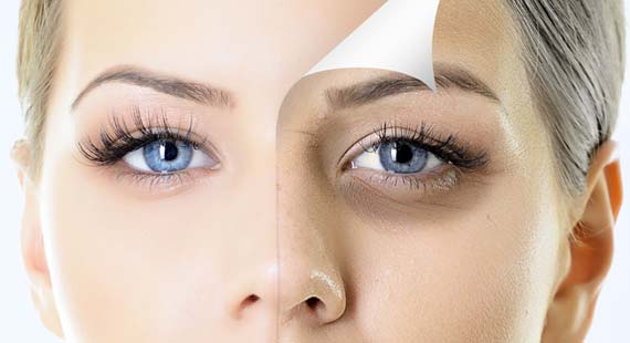 Ways to get rid of dark circles under eyes fast