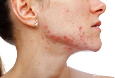 Home remedies for acne and pimples