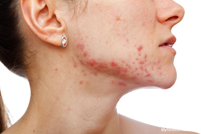 Home remedies for acne and pimples