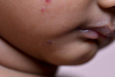 New Chickenpox Virus Variant in India